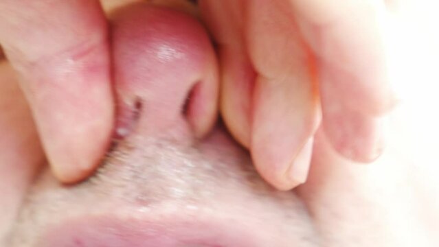 nostrils close-up. the man blows his nose. snot and mucus due to illness. the concept of seasonal SARS and influenza.