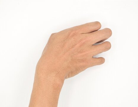 Cerebral palsy hand in Asian young male patient. Typically seen in hemiplegia and quadriplegia. Wrist joint flexion with ulnar deviation.