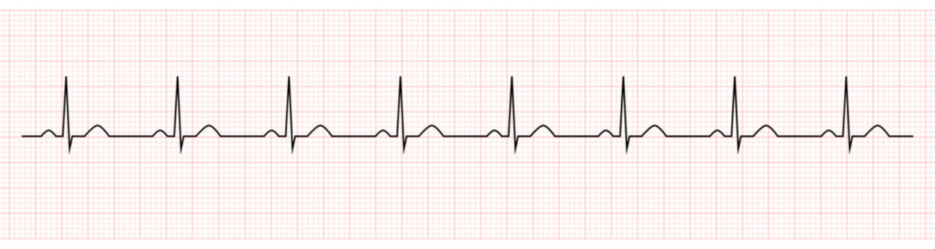 Normal Sinus Rhythm" Images – Browse 4,126 Stock Photos, Vectors, and Video  | Adobe Stock