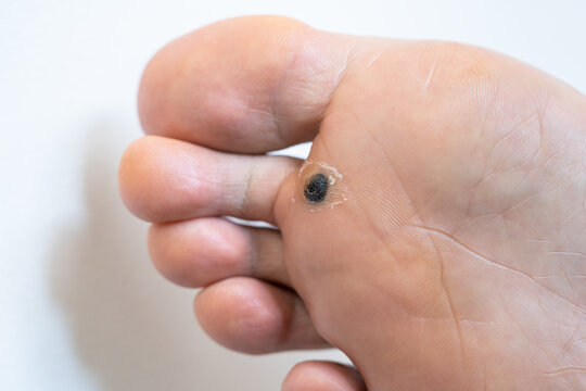 Closeup of dead skin around wart plantar after cauterizing it with celandine on infected foot. Hygiene, human skin disease, papillomavirus or HPV concept. Self-medication. 