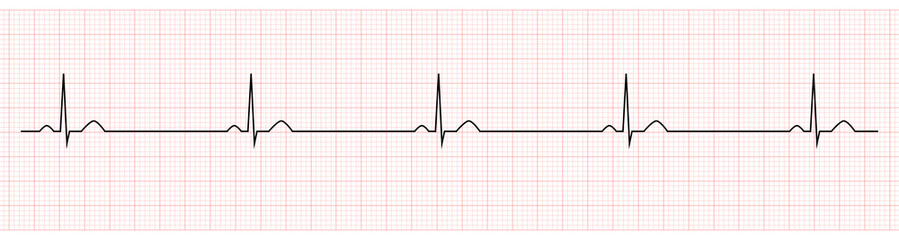 EKG Showing Sinus Bradycardia of Patient 
