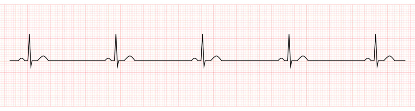 EKG Showing Sinus Bradycardia of Patient 