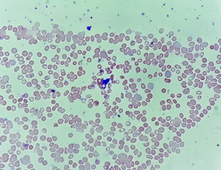 Microscopic view of hematological slide showing Pancytopenia. A condition in which there is a lower...