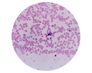 Microscopic view of hematological slide showing Pancytopenia. A condition in which there is a lower...