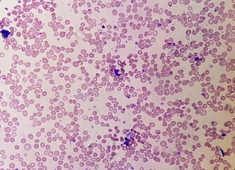 Microscopic view of hematological slide showing Pancytopenia. A condition in which there is a lower...