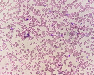 Microscopic view of hematological slide showing Pancytopenia. A condition in which there is a lower number of RBC, WBC and platelets in the blood.