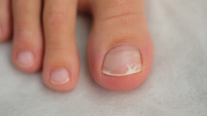Damaged toenail close up, shallow depth of field.