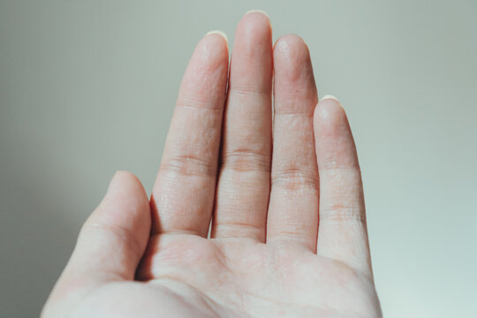 A man hand palm with dyshidrotic or pompholyx eczema illness