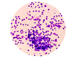 Synovial Fluid Cytology: Plenty WBC, microscopic examination of synovial fluid, to diagnose arthritis, particularly for septic or crystal-induced arthritis.