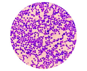 Synovial Fluid Cytology: Plenty WBC, microscopic examination of synovial fluid, to diagnose arthritis, particularly for septic or crystal-induced arthritis.