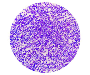 Synovial Fluid Cytology: Plenty WBC, microscopic examination of synovial fluid, to diagnose arthritis, particularly for septic or crystal-induced arthritis.