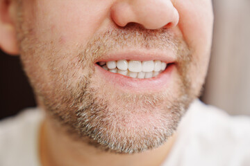 Fototapeta premium close-up. the man's mouth with stubble smiles and shows white teeth. the concept of dental services, whitening and veneers.