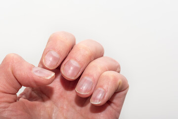 Close-up of a Caucasian female hand with natural unpolished nails, overgrown cuticles