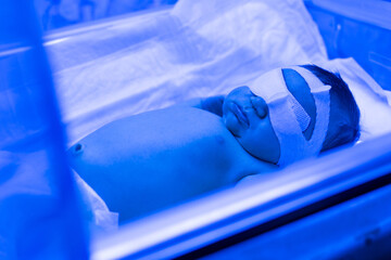A newborn baby lies under ultraviolet lamps, under blue light. High bilirubin, treatment of childhood jaundice, ultraviolet incubator.