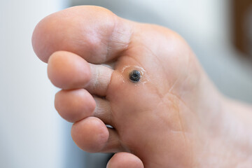Closeup of dead skin around wart plantar after cauterizing it with celandine on infected foot. Hygiene, human skin disease, papillomavirus or HPV concept. Self-medication.  - obrazy, fototapety, plakaty