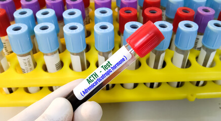 Blood sample for Adrenocorticotropic hormone (ACTH) test, diagnosis of Addison's disease with laboratory background.