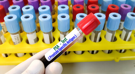 Blood sample for PSA (Prostate-specific antigen) test. To diagnosis for prostate cancer.