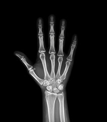 xray image of both hand AP view isolated on black  background  for diagnostic rheumatoid.
