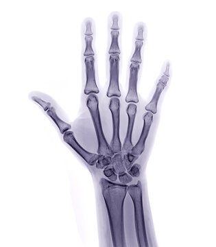 xray image of both hand AP view isolated on white background  for diagnostic rheumatoid.
