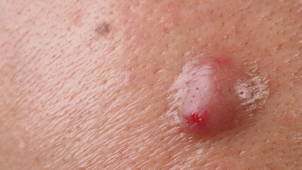 Bacterial skin infection. Big Acne Cyst Abscess or Ulcer Swollen area within face skin tissue....