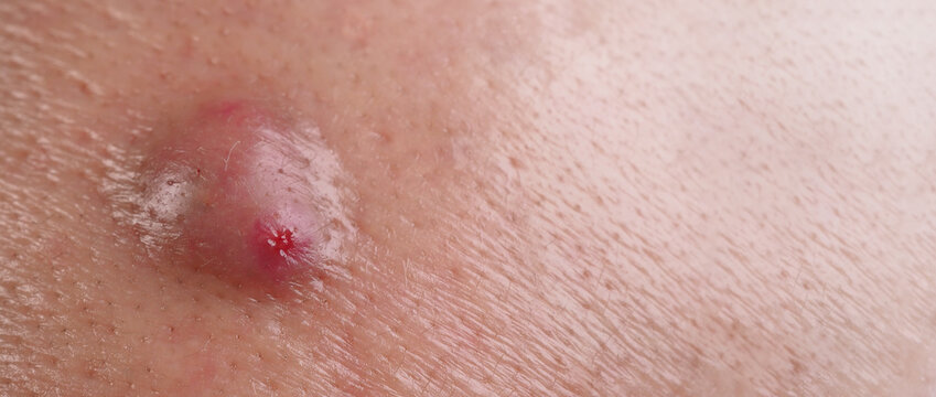 Bacterial skin infection. Big Acne Cyst Abscess or Ulcer Swollen area within face skin tissue. Containing accumulation of pus and blood. Macro shot of Acne or Dermatitis near mouth on face. Skincare.