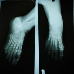 X-Ray of the left foot