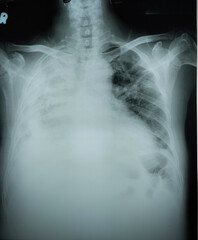 X-Ray of the chest of an adult male with right pulmonary edema