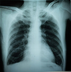 Normal male chest x-ray