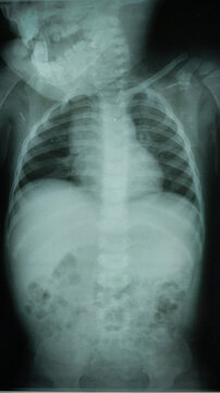 X Ray baby with an abnormal heart picture