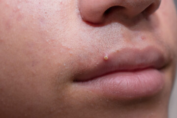 close up of a acne