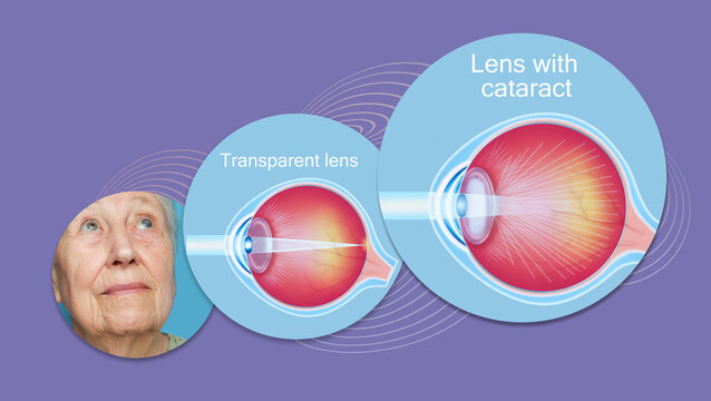 รูปภาพFovea เลือกดูภาพถ่ายสต็อก เวกเตอร์ และวิดีโอ420 Adobe Stock