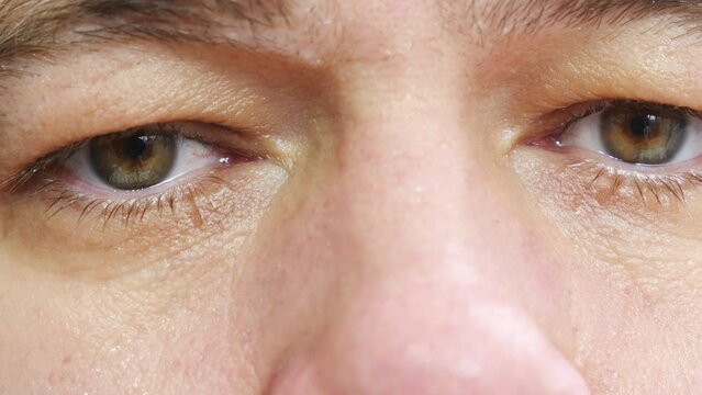 close-up. tired sleepy male eyes. the concept of insomnia, fatigue and problems with sleep and rest.