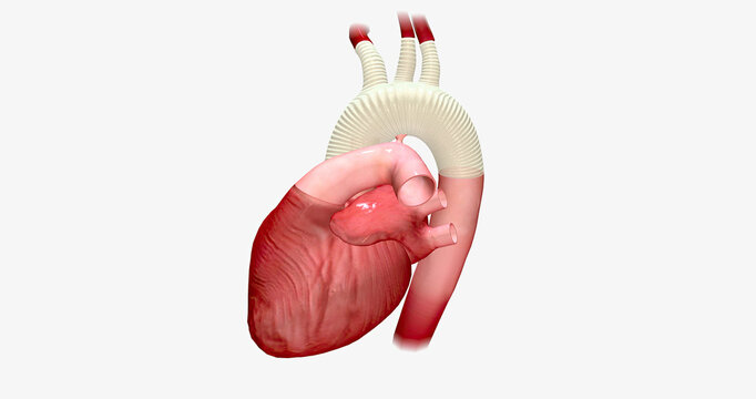 The Enlarged Portion Of The Aortic Arch Is Replaced With A Synthetic Graft.