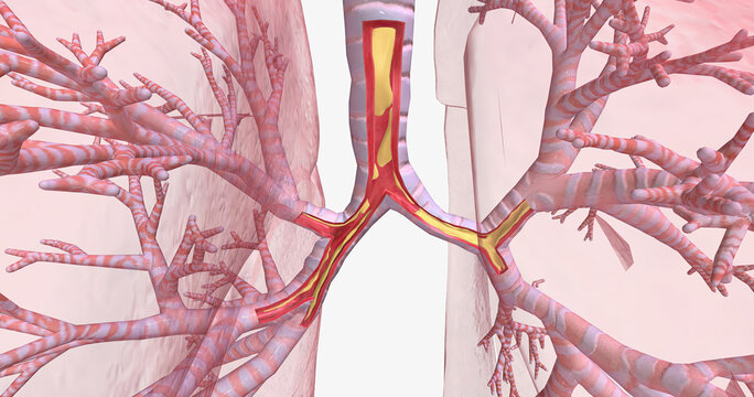 Inflammation And Constriction Of Airways