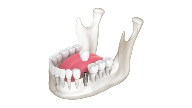 Mandible with dental implant placement procedure over white background