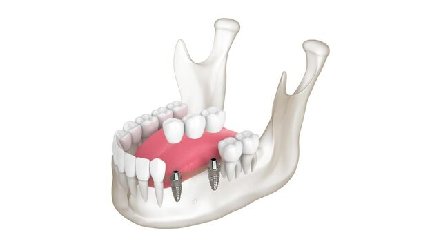 Dental bridge fixed to the mandible with two implants over white background