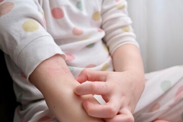 Obraz na płótnie Canvas The child scratches atopic skin. The child applies a special cream to atopic skin. Dermatitis, diathesis, allergy on the child's body. 