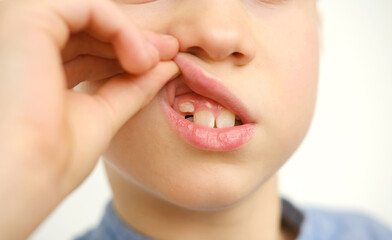 close-up hand of child, boy of 9 years old points new tooth fang in mouth with finger, concept of...