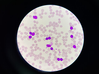 Chronic lymphocytic leukemia.