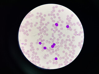 Chronic lymphocytic leukemia.