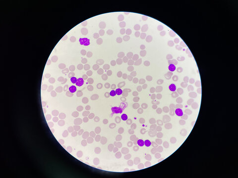 Chronic lymphocytic leukemia.