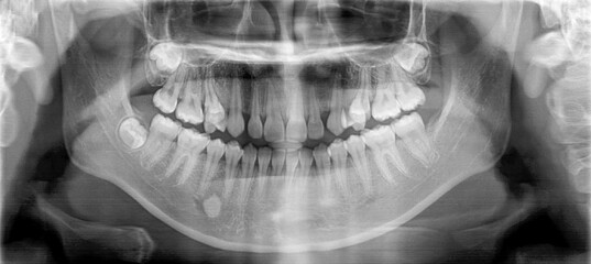 Film panoramic radiography view of the jaw.Multiple embedded and impaction teeth at both maxilla and mandible area.Panoramic dental and mandible x-ray image. - obrazy, fototapety, plakaty