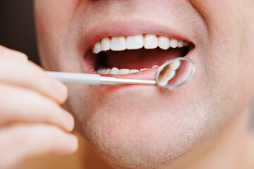 close-up. examination of teeth with veneers with a special dental mirror. the concept of dental and oral hygiene.