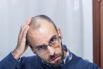 Young man with alopecia looking at his head and hair in the mirror