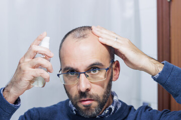 Young man with alopecia looking at his head and hair in the mirror and applying a spray medicine at home