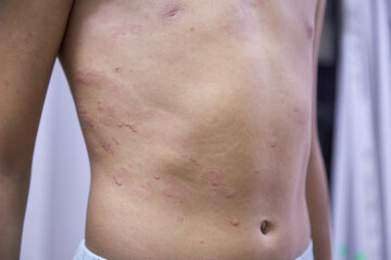 Naklejka premium food allergy. a boy with red spots. The child has itching, with an allergic rash..