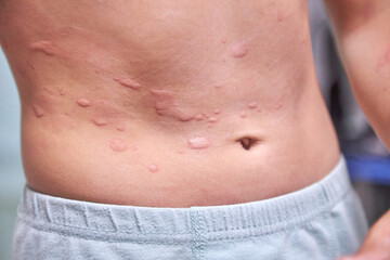 Naklejka premium food allergy. a boy with red spots. The child has itching, with an allergic rash..