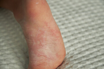 Fototapeta premium food allergy. a boy with red spots. The child has itching, with an allergic rash..