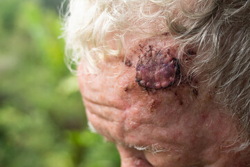 Surgery wound for excision of a BCC skin cancer with skin graft on the forehead of a senior male...