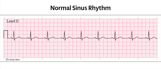 ECG Normal Sinus Rhythm - 8 Second ECG Paper - Vector Medical Illustration